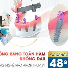 IMPLANT NHA KHOA I-DENT 6